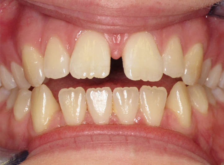 before-anterior-teen