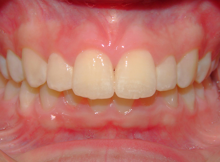 before-anterior-girl