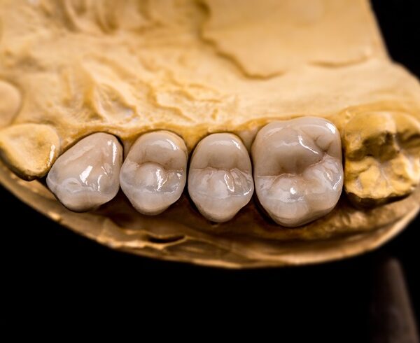 Dental prosthesis