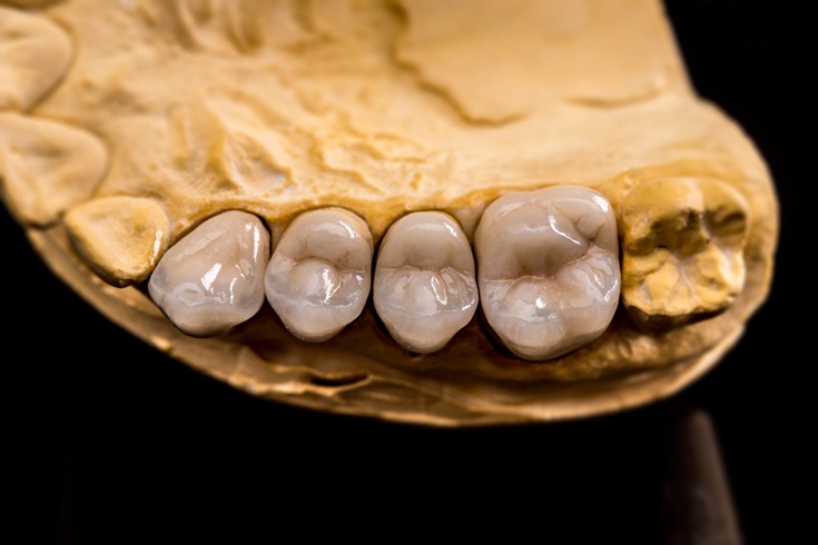 Dental prosthesis