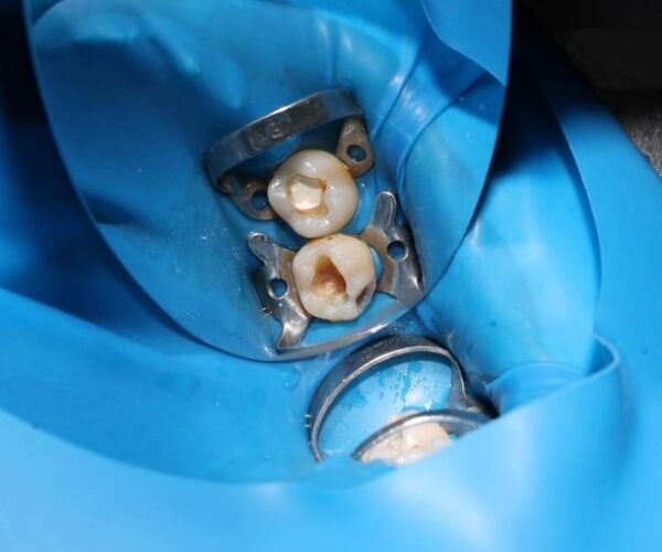 Poor Diet Cause Bone Graft Failure