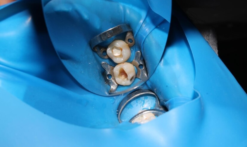 Poor Diet Cause Bone Graft Failure