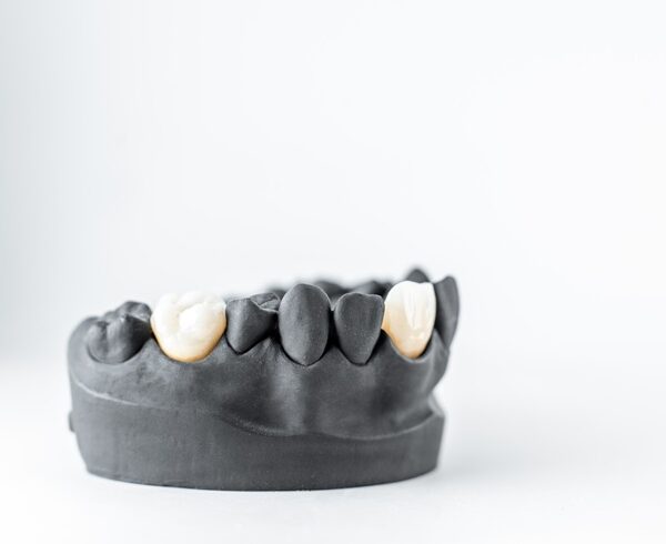 Model of artificial jaw with dental implant