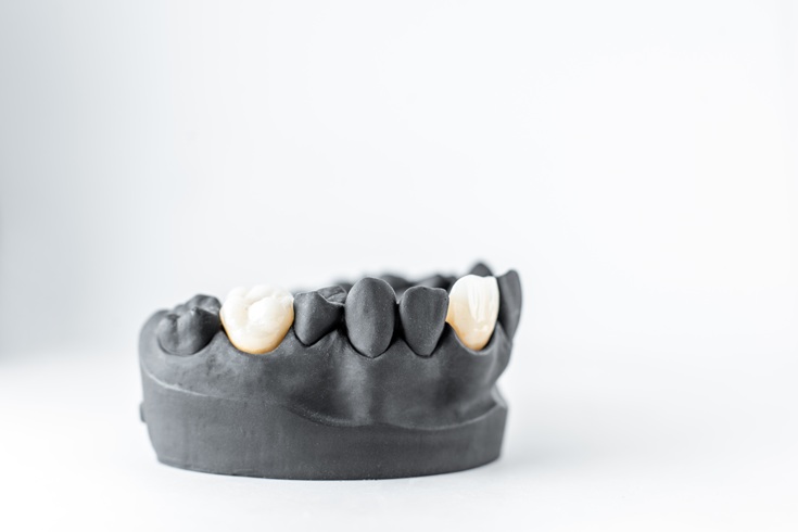 Model of artificial jaw with dental implant