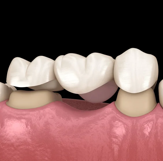 dental-bridge-in-phoenix