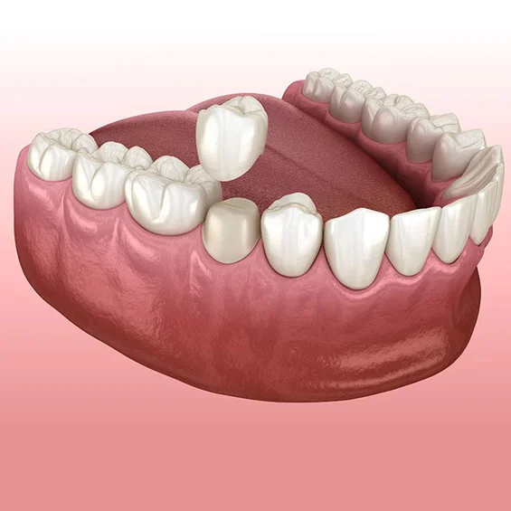 dental-crowns-phoenix