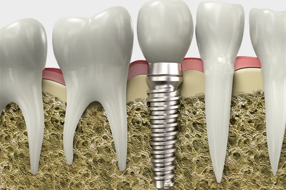 dental-implant-phoenix