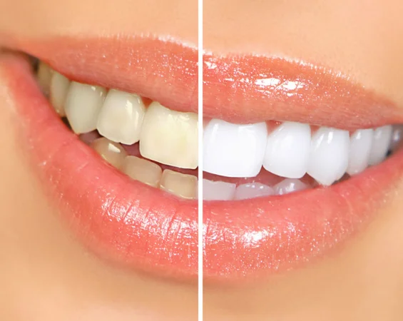 teeth-whitening-phoenix
