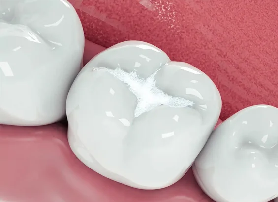 white-filling-in-phoenix